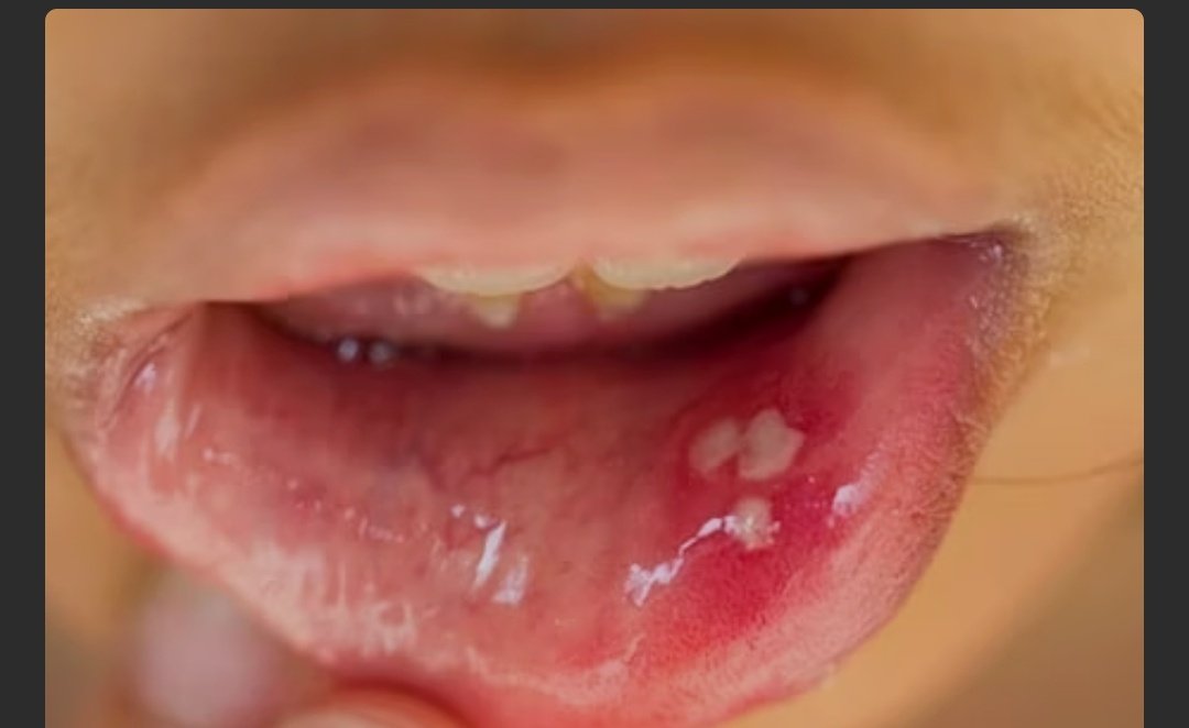 मुंह के छालों से राहत पाने में मदद करेंगे 3 घरेलू नुस्खे, तुरंत आजमाएं और छालों से हमेशा के लिए छुटकारा पाएं 1 Screenshot 20250829 201602