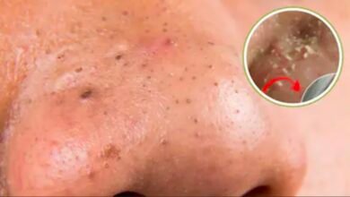 चेहरे के ब्लैकहेड्स कैसे साफ करें? स्किन एक्सपर्ट ने बताए 3 सबसे असरदार तरीके 5 Screenshot 20260925 123044